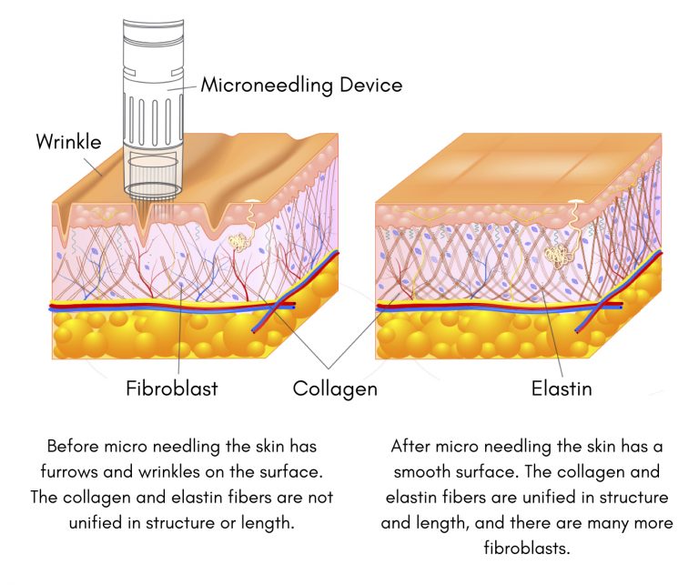 Microneedling Oasis Wellbeing Clinic microneedling-oasis-wellbeing-clinic
