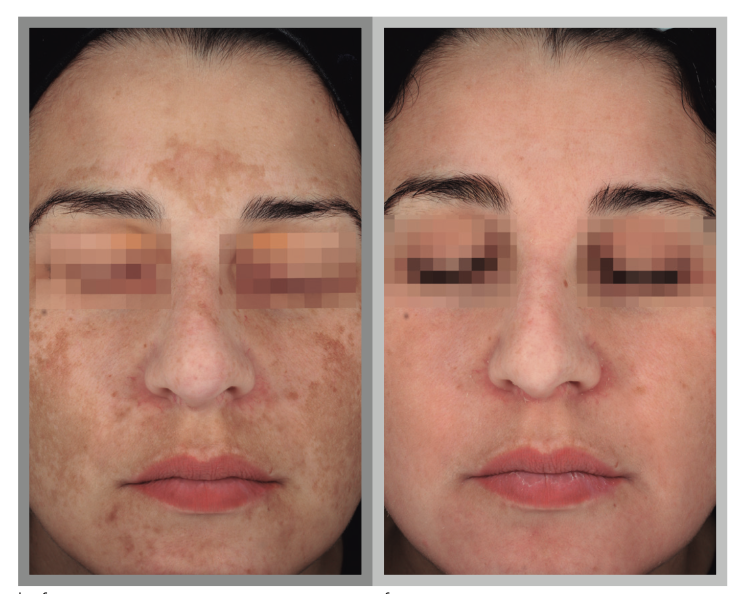 cosmelan treatment blackpool