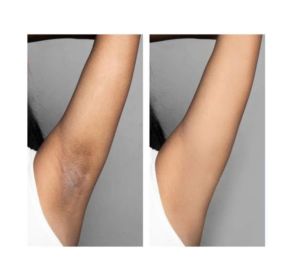 dermamelan intimate before and after underarms oasis wellbeing clinic