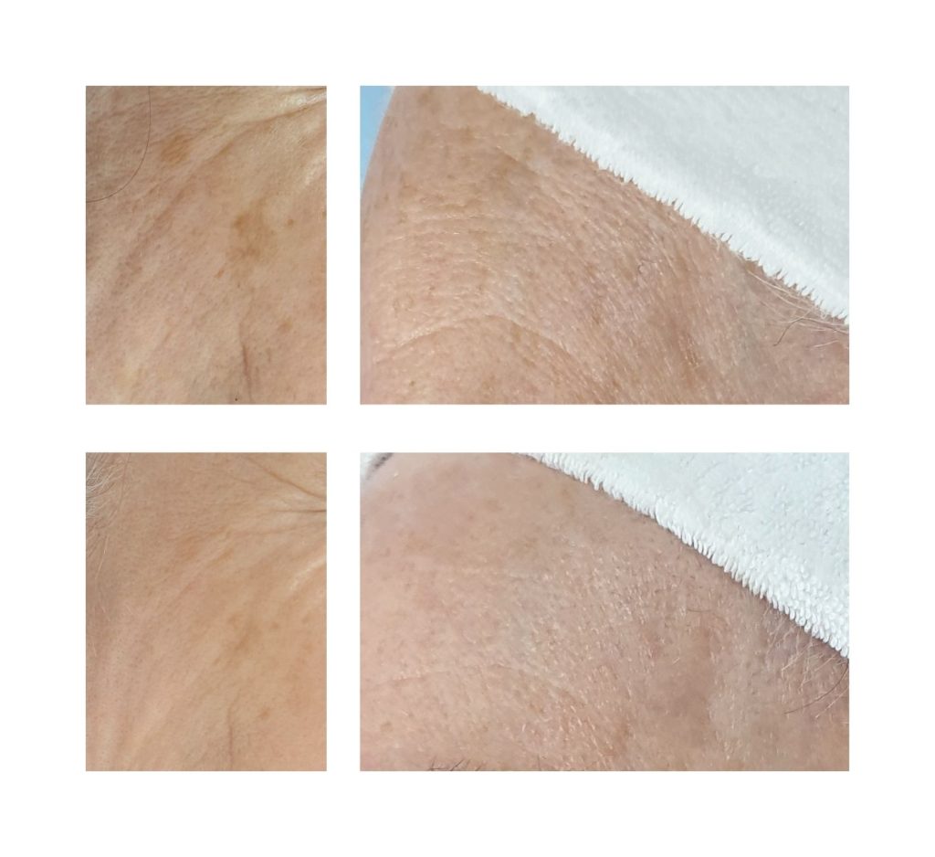 Co2 pigmentation removal oasis wellbeing clinic