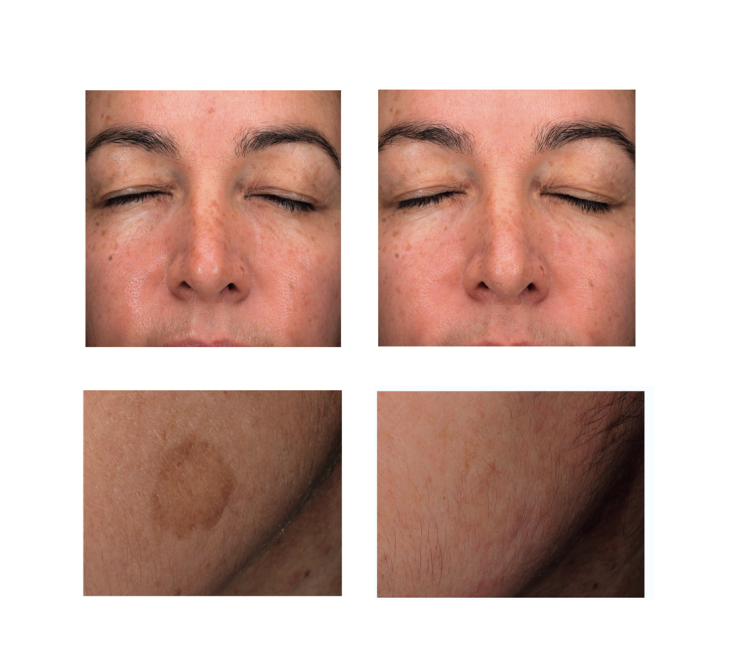 chemical peels for pigmentation oasis wellbeing clinic