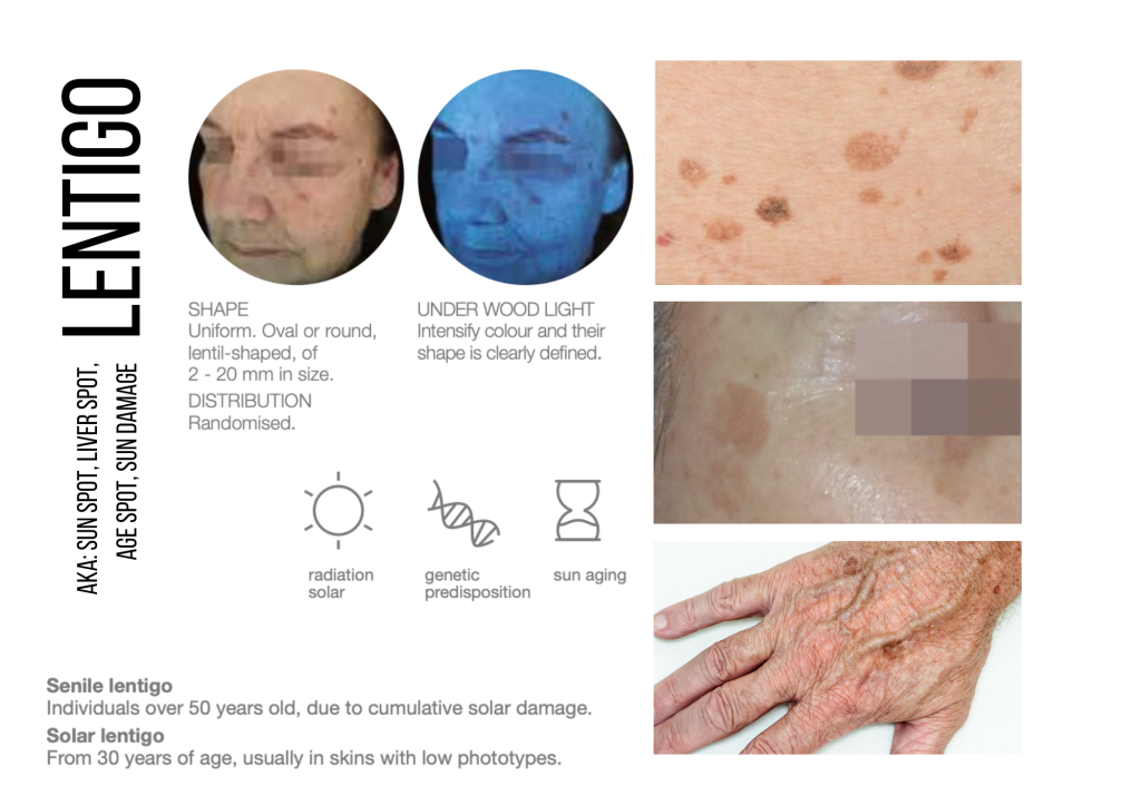 lentigo sun spot age spot oasis well being clinic