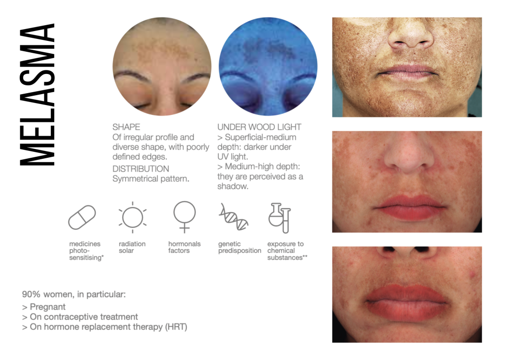 melasma information oasis wellbeing clinic