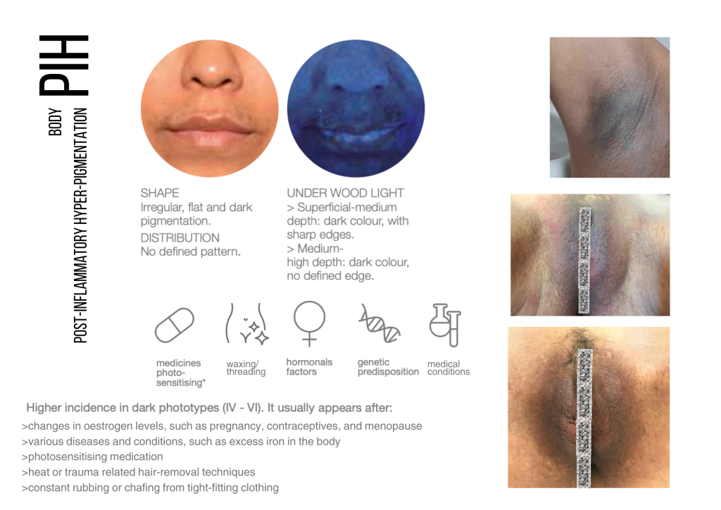 body Post Inflammatory Hyper-Pigmentation (PIH)