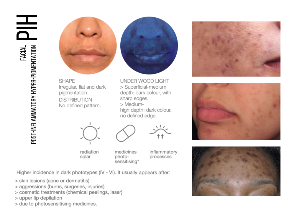 post inflammatory hyperpigmentation oasis wellbeing clinic
