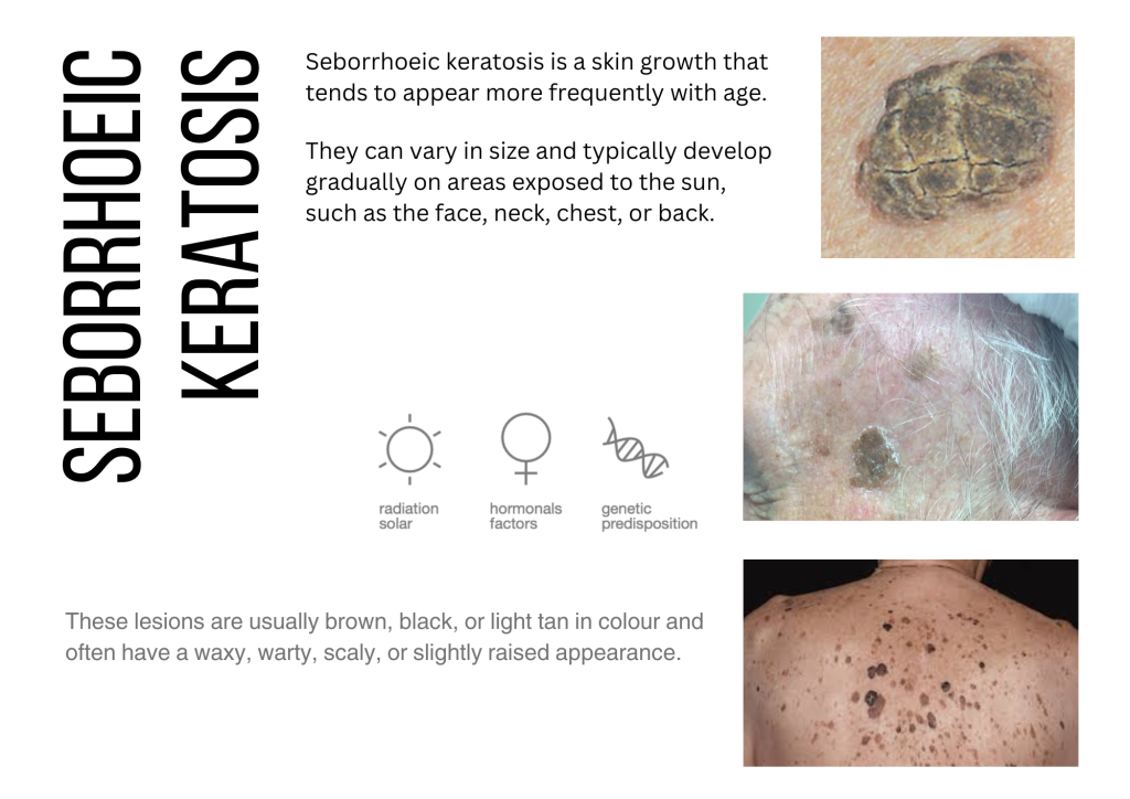 seborrheic keratosis oasis wellbeing clinic